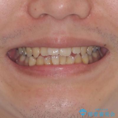 オープンバイトと目立つ銀歯　インビザライン矯正とセラミック修復治療 治療前画像