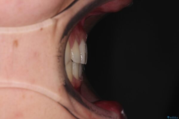 著しいディープバイトと隙間だらけの歯列　 治療後画像