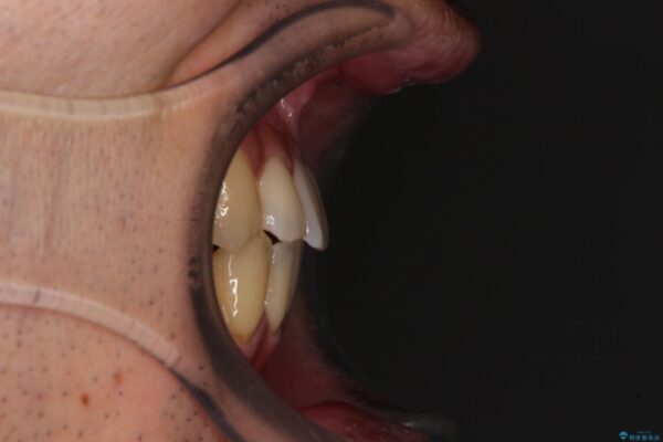 ワイヤー装置での上下前歯の部分矯正 治療後画像
