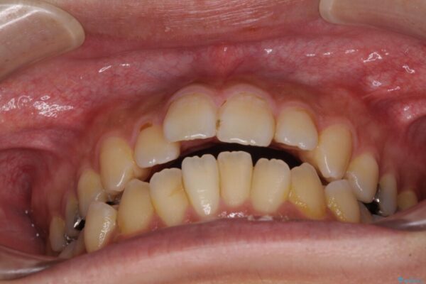 オープンバイトと目立つ銀歯　インビザライン矯正とセラミック修復治療 治療前画像