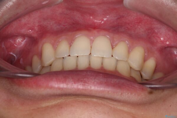 著しいディープバイトと隙間だらけの歯列　 治療後画像