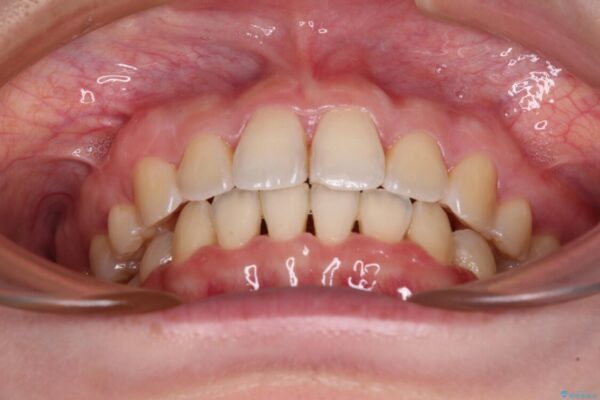 【モニター】短期間で口の閉じにくさを改善　ワイヤー装置での抜歯矯正 治療後画像