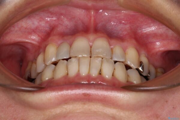 急速拡大装置　前歯の反対咬合をインビザラインで改善 治療後画像