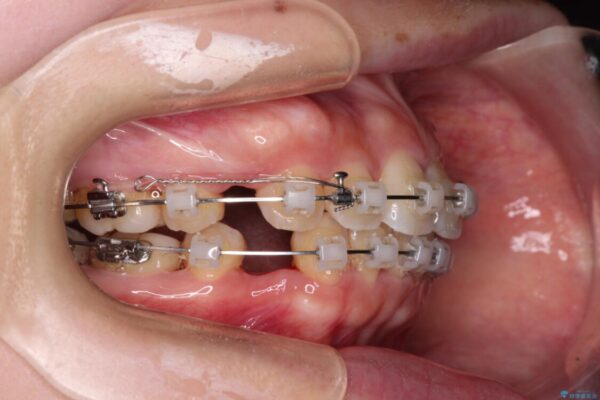 【モニター】短期間で口の閉じにくさを改善　ワイヤー装置での抜歯矯正 治療途中画像