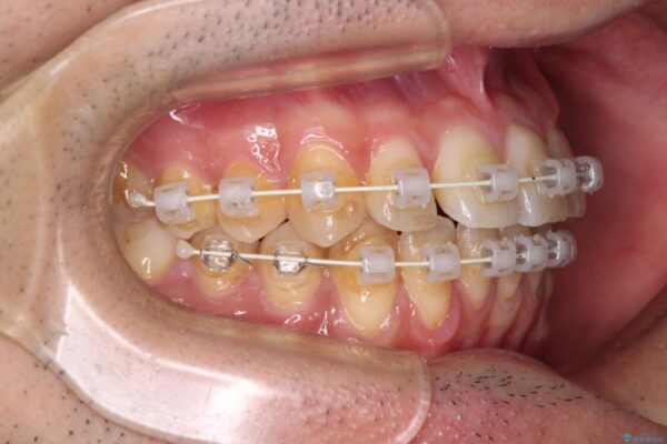 ワイヤー装置での上下前歯の部分矯正 治療途中画像