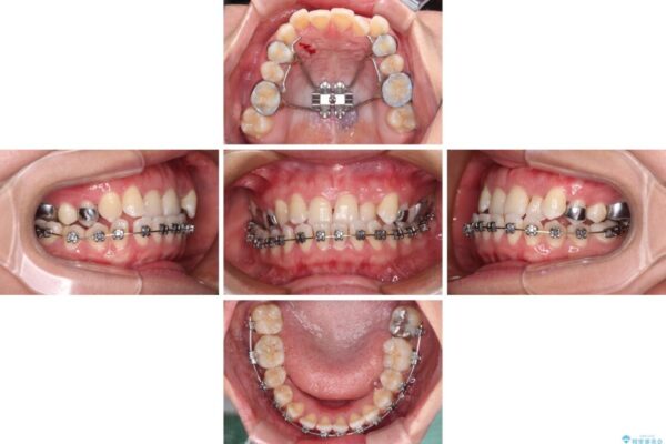 前歯の反対咬合　急速拡大装置とワイヤー装置であっという間の矯正治療 治療途中画像