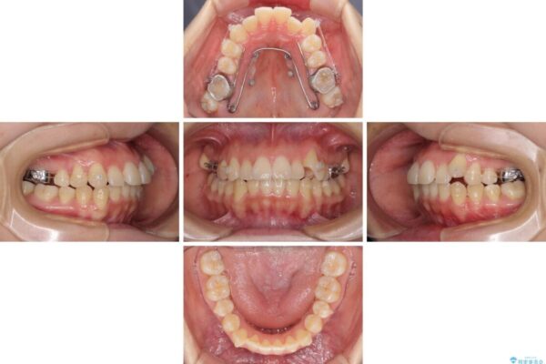 狭い歯列を拡大　拡大装置を併用したインビザライン矯正 治療途中画像