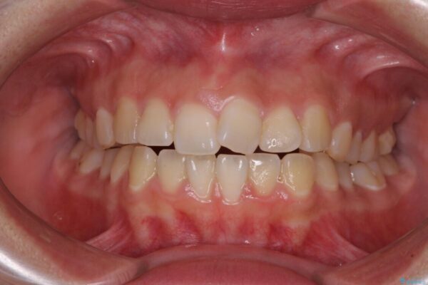 【モニター】カリエールディスタライザーとインビザラインを用いた奥歯の咬み合わせ改善 治療前画像