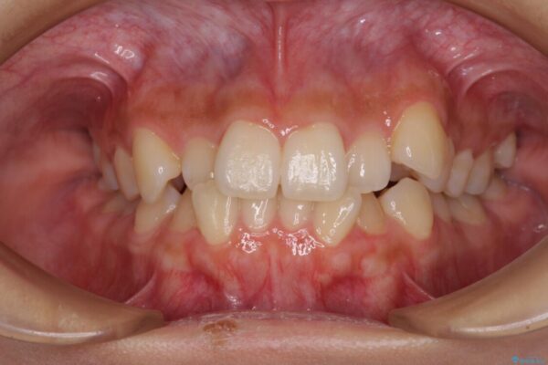 デコボコと八重歯の目立つ前歯　ワイヤー装置による抜歯矯正 ビフォー