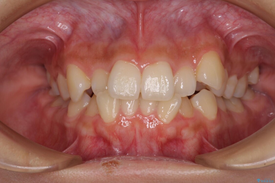 デコボコと八重歯の目立つ前歯　ワイヤー装置による抜歯矯正 治療前