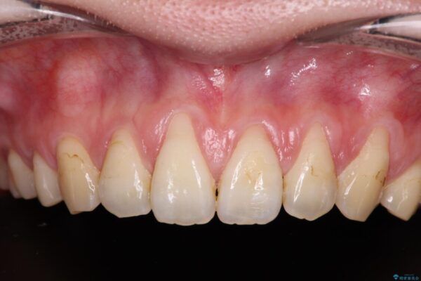 矯正治療で退縮してしまった歯肉　歯肉移植で自然な前歯に 治療前画像
