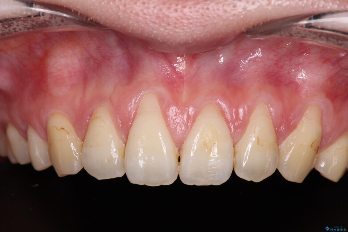 矯正治療で退縮してしまった歯肉　歯肉移植で自然な前歯に 治療前