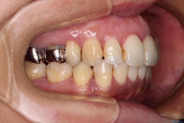 内側に倒れた前歯と口元の突出感　ワイヤー装置での抜歯矯正 治療後画像