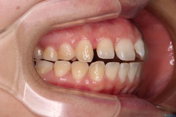 【モニター】カリエールディスタライザーとインビザラインを用いた奥歯の咬み合わせ改善 治療途中画像