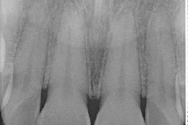 転んで欠けてしまった前歯　オーダーメイドのオールセラミッククラウン 治療前画像