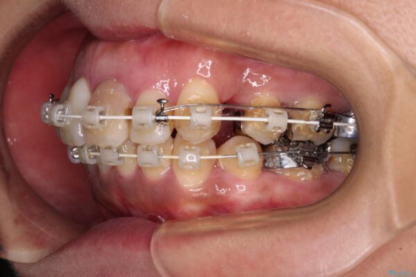 内側に倒れた前歯と口元の突出感　ワイヤー装置での抜歯矯正 治療途中画像