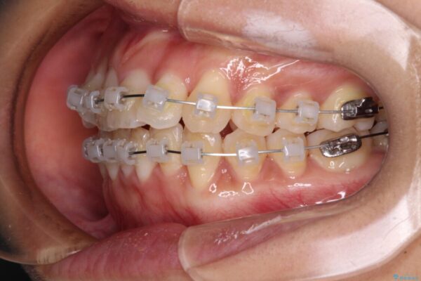 捻れた前歯をできるだけ短期間で　表側のワイヤー矯正 治療途中画像