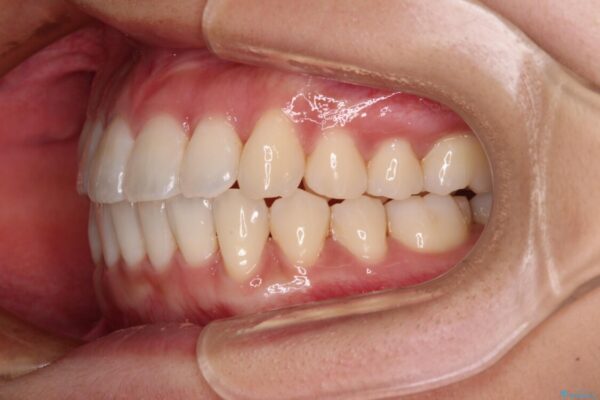 捻れた前歯をできるだけ短期間で　表側のワイヤー矯正 治療後画像