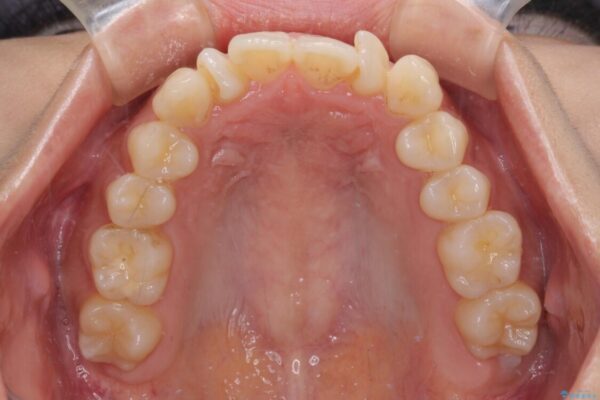 捻れた前歯をできるだけ短期間で　表側のワイヤー矯正 治療前画像