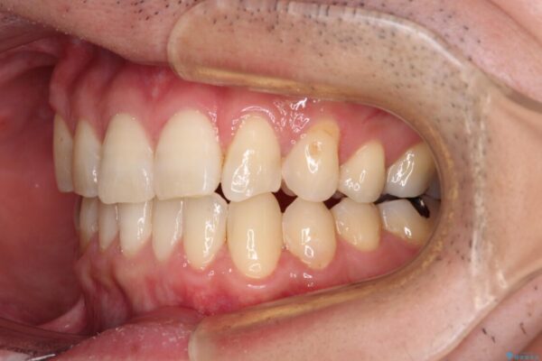 欠損のある歯列　インビザラインで整った歯並びに 治療後画像
