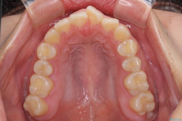 【モニター】カリエールディスタライザーとインビザラインを用いた奥歯の咬み合わせ改善 治療前画像