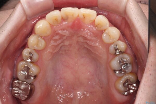 欠損のある歯列　インビザラインで整った歯並びに 治療途中画像