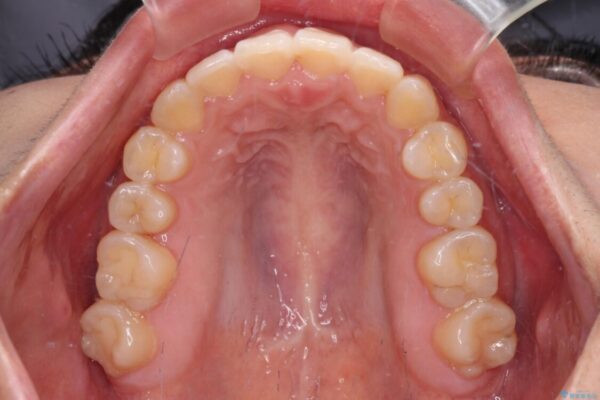 【モニター】カリエールディスタライザーとインビザラインを用いた奥歯の咬み合わせ改善 治療後画像