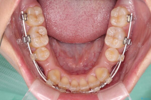 デコボコと八重歯の目立つ前歯　ワイヤー装置による抜歯矯正 治療途中画像