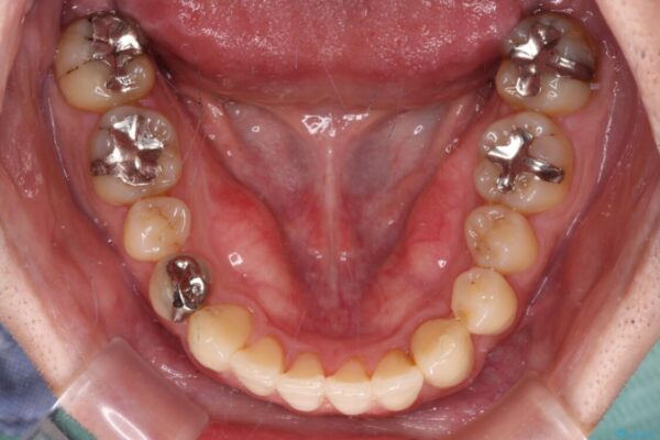 欠損のある歯列　インビザラインで整った歯並びに 治療途中画像
