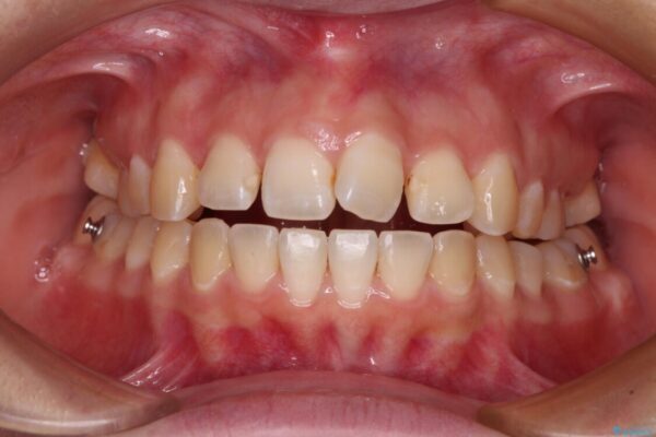 【モニター】カリエールディスタライザーとインビザラインを用いた奥歯の咬み合わせ改善 治療途中画像