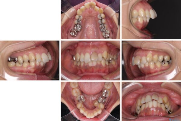 内側に倒れた前歯と口元の突出感　ワイヤー装置での抜歯矯正 治療前画像