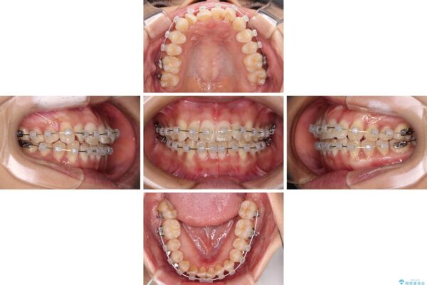 捻れた前歯をできるだけ短期間で　表側のワイヤー矯正 治療途中画像
