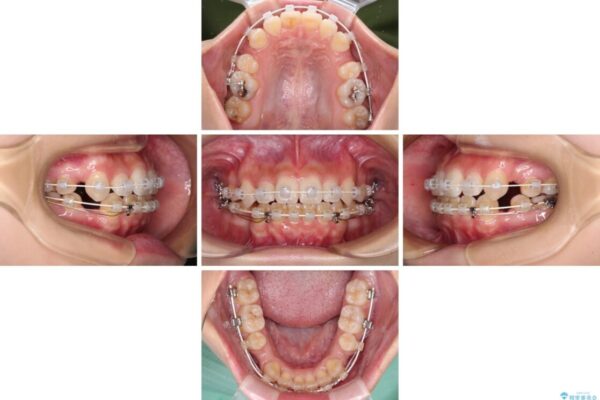 デコボコと八重歯の目立つ前歯　ワイヤー装置による抜歯矯正 治療途中画像