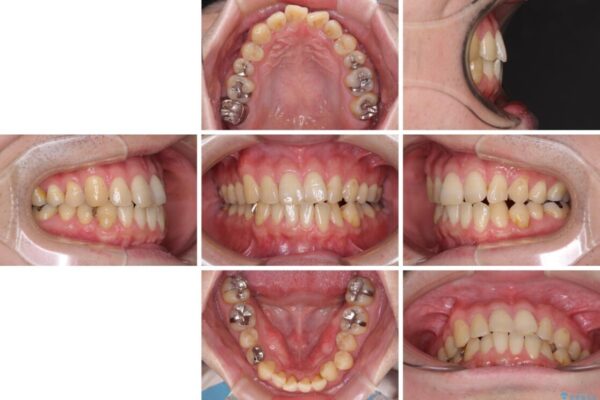 欠損のある歯列　インビザラインで整った歯並びに 治療前画像