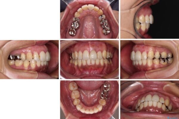 内側に倒れた前歯と口元の突出感　ワイヤー装置での抜歯矯正 治療後画像