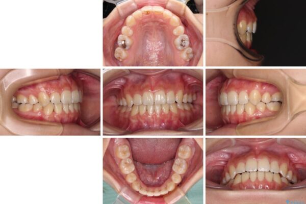 デコボコと八重歯の目立つ前歯　ワイヤー装置による抜歯矯正 治療後画像
