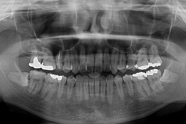 捻れた前歯をインビザラインでスッキリと 治療前画像