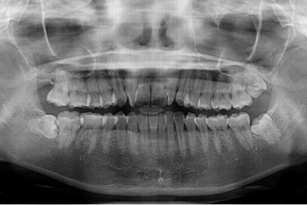 捻れた前歯をできるだけ短期間で　表側のワイヤー矯正 治療前画像