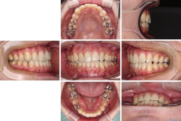 欠損のある歯列　インビザラインで整った歯並びに 治療後画像