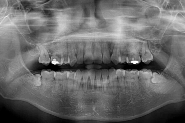 デコボコと八重歯の目立つ前歯　ワイヤー装置による抜歯矯正 治療後画像