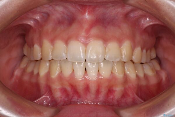 【モニター】カリエールディスタライザーとインビザラインを用いた奥歯の咬み合わせ改善 アフター