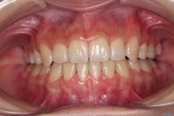 デコボコと八重歯の目立つ前歯　ワイヤー装置による抜歯矯正 アフター