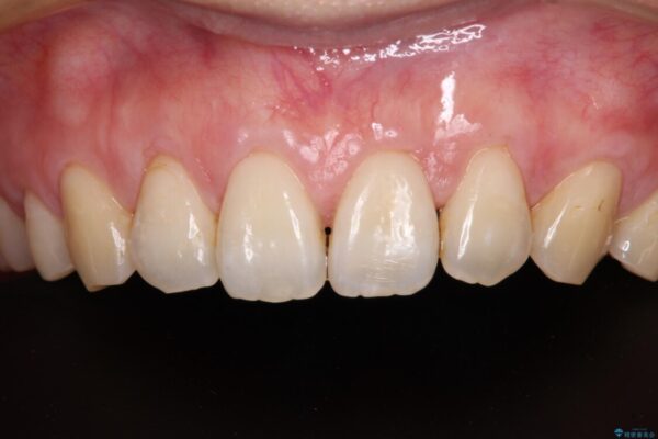 矯正治療で退縮してしまった歯肉　歯肉移植で自然な前歯に 治療後画像