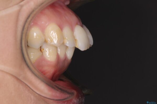 内側に倒れた前歯と口元の突出感　ワイヤー装置での抜歯矯正 治療前画像