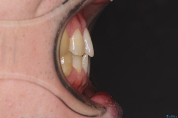 欠損のある歯列　インビザラインで整った歯並びに 治療前画像