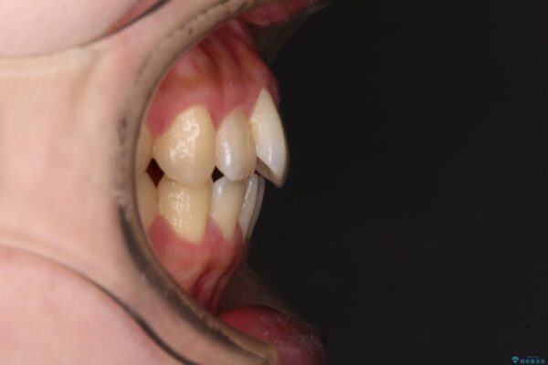 捻れた前歯をインビザラインでスッキリと 治療前画像