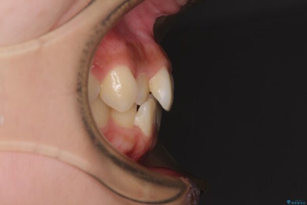 デコボコと八重歯の目立つ前歯　ワイヤー装置による抜歯矯正 治療前画像