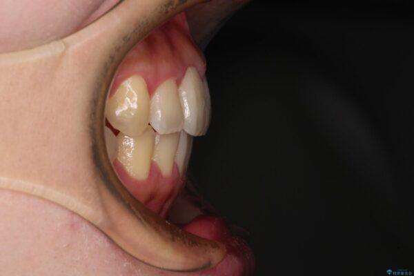 捻れた前歯をインビザラインでスッキリと 治療後画像