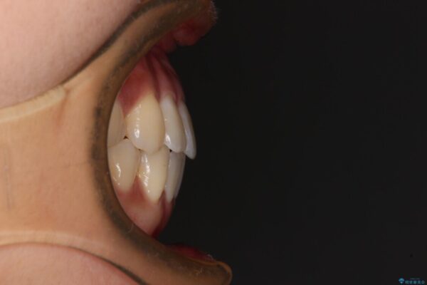 捻れた前歯をできるだけ短期間で　表側のワイヤー矯正 治療後画像
