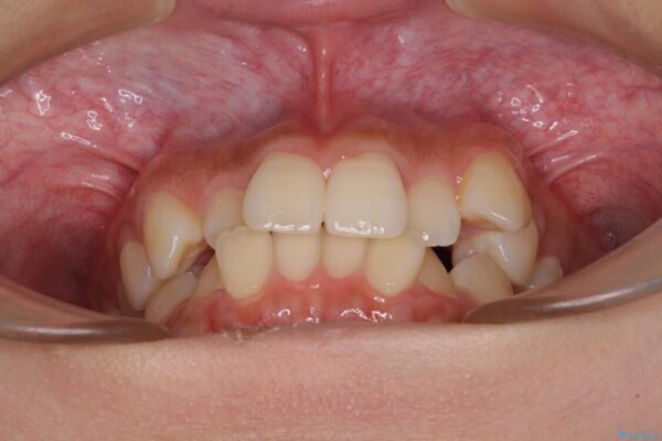 デコボコと八重歯の目立つ前歯　ワイヤー装置による抜歯矯正 治療前画像